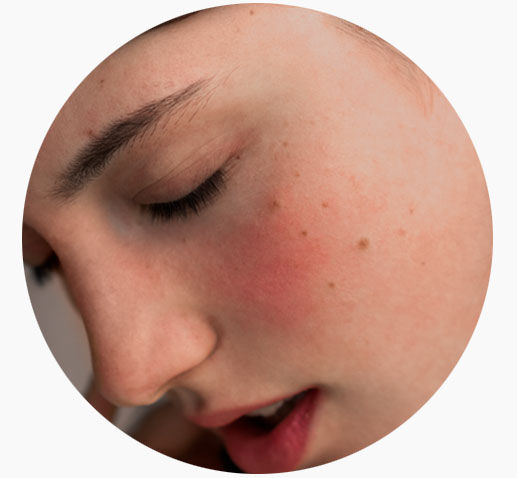 Imagen categoría piel sensible con una mujer con ojos cerrados y piel enrojecida 